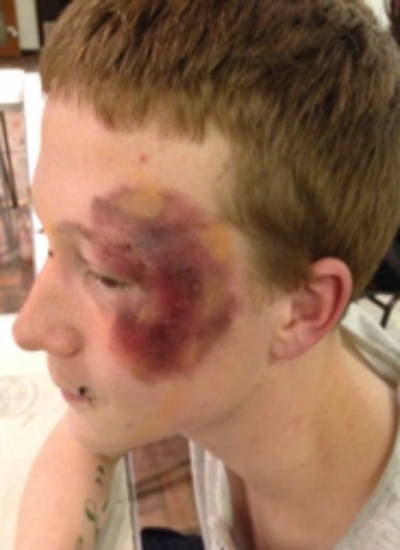 Bruised Actor