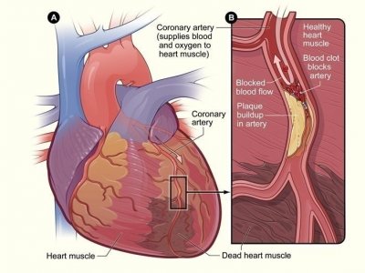 Cardiovascular_disease 01